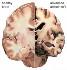 Alzheimer
