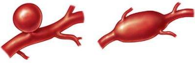Aneurysma