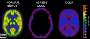 Vaststellen hersendood kan sneller