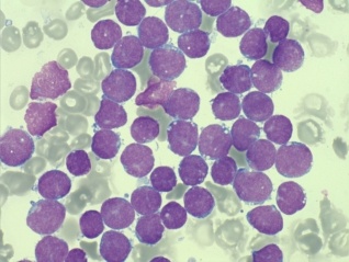 Leukemie