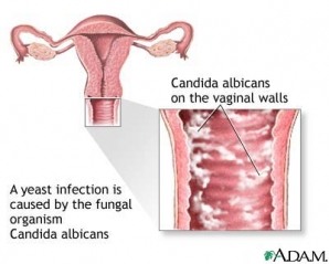 Vaginale schimmelinfectie