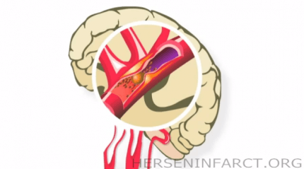 Overleving na herseninfarct gestegen