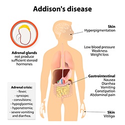 Ziekte van Addison