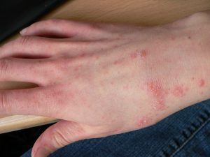 Schurft onder studenten neemt toe