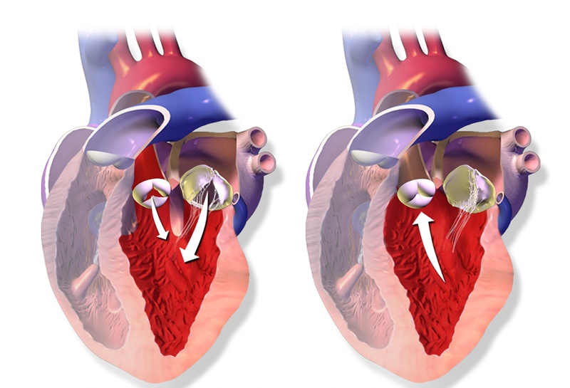 Aortaklepstenose