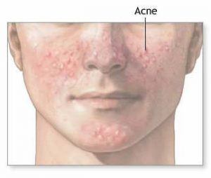 Trekken kern smal Wat is acne en wat zijn jeugdpuistjes? | Gezondheid informatie